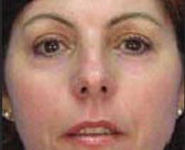 MicroLaserPeel® Treatment