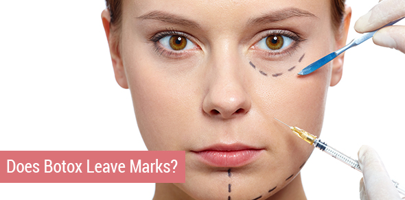 Does Botox Leave Marks