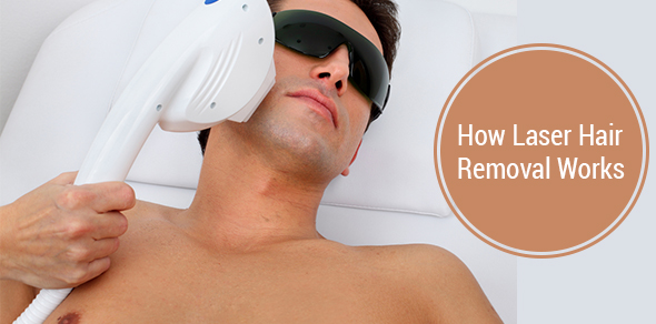 How Laser Hair Removal Works