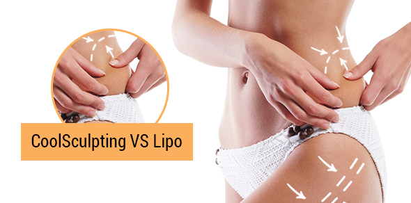 CoolSculpting VS Lipo