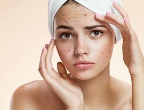 Acne- is becoming a problem?