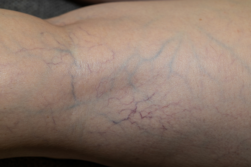 close up of leg veins